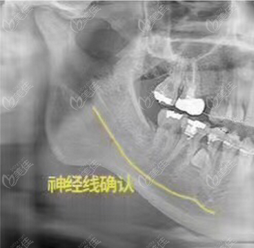 何锦泉做下颌角做的怎么样www.236z.com