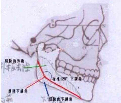 徐威强下颌角做的怎么样