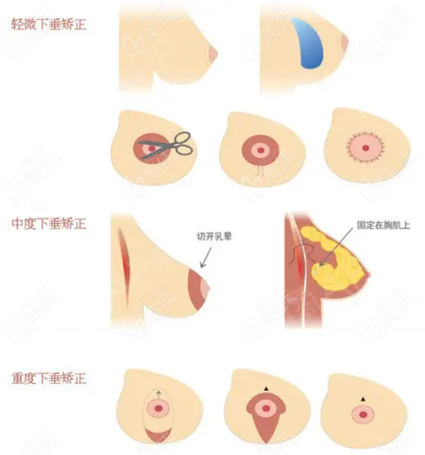 重庆松山医院做乳房下垂矫正手术费用不高技术也好，这两天松山乳房下垂矫正16812元起活动海报五