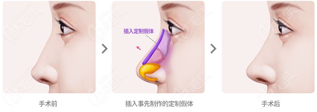韩国乐日整形外科医院隆鼻手术过程图解