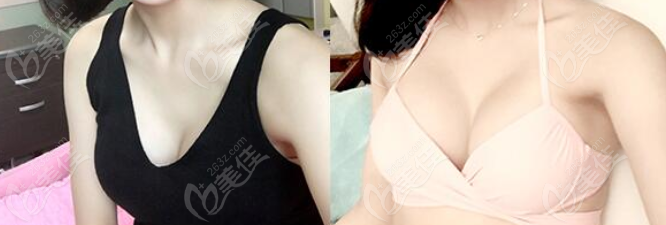 孙瑜离院长假体隆胸修复对比图236z.com 孙瑜离院长假体隆胸修复对比图236z.com