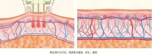 黄金微针4.0治疗皮肤问题过程