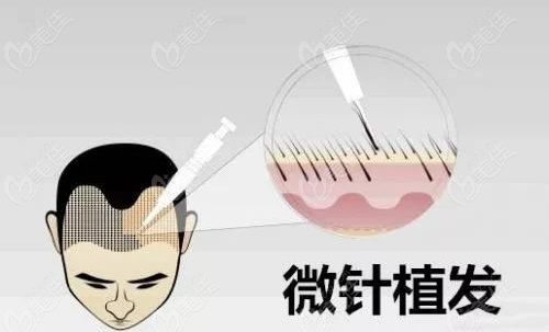 广州荔医植发优惠中头发加密比植发贵