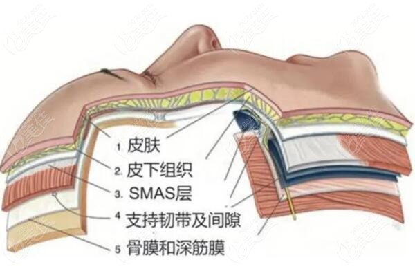 筋膜提拉术手术全过程
