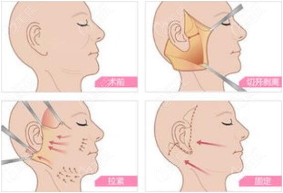 筋膜提拉术手术图来m.236z.com