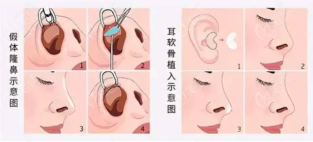耳软骨隆鼻过程图
