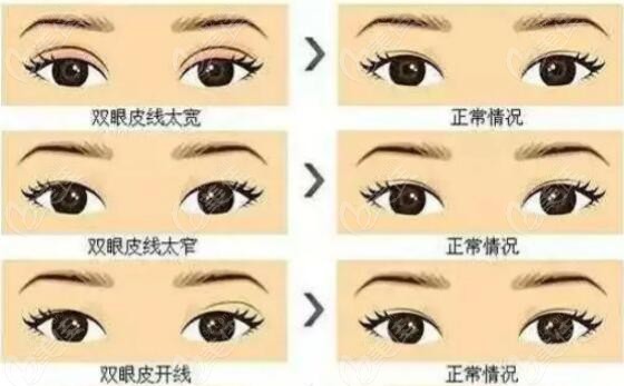 沈阳杜继凤做双眼皮修复优势