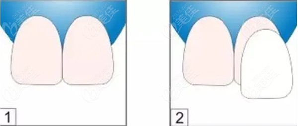 牙齿贴面示意图236z.com