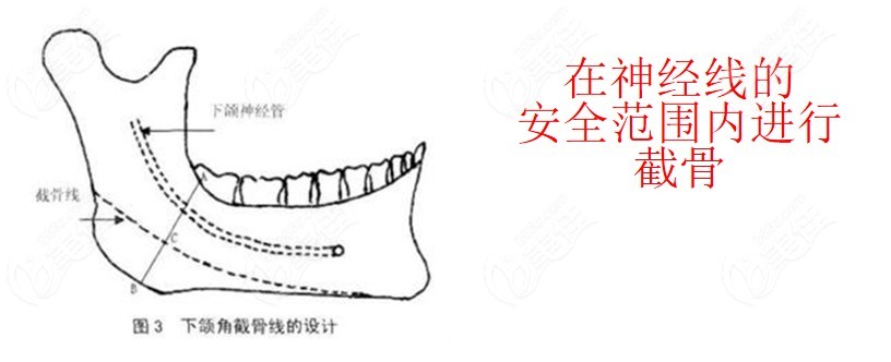 张笑天做下颌角截骨手术特色236z.com分享