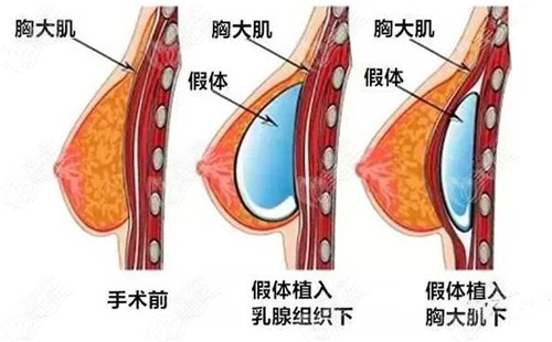 钦州华美做假体隆胸技术好