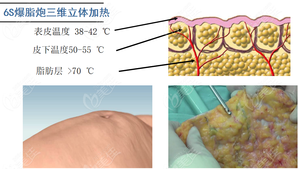 爆脂炮的原理主要是溶脂