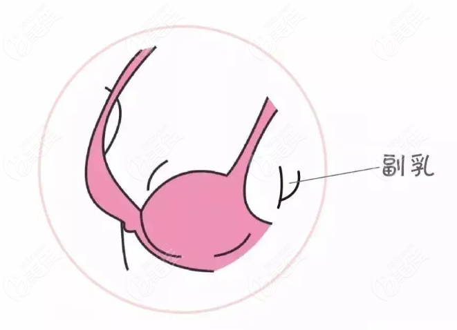 副乳手术图解图片