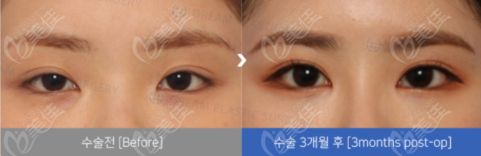 韩国梦想双眼皮修复实例图