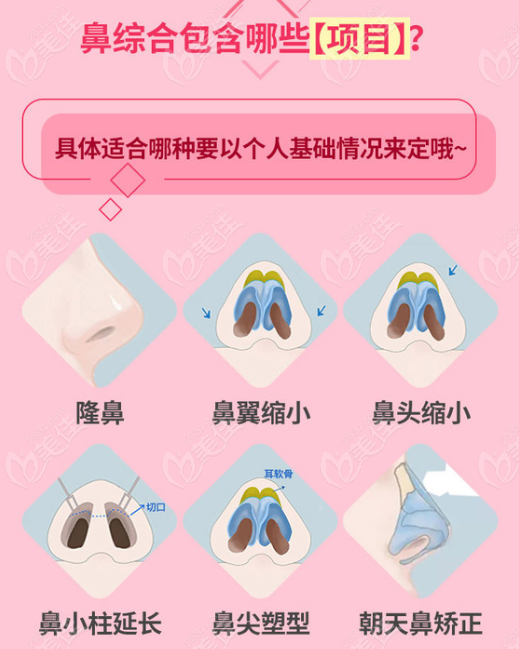 上海天大鼻综合隆鼻包含哪些项目