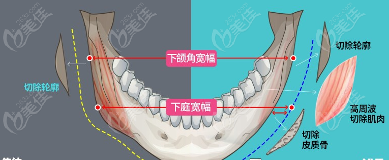 北京磨骨医生怎么预约