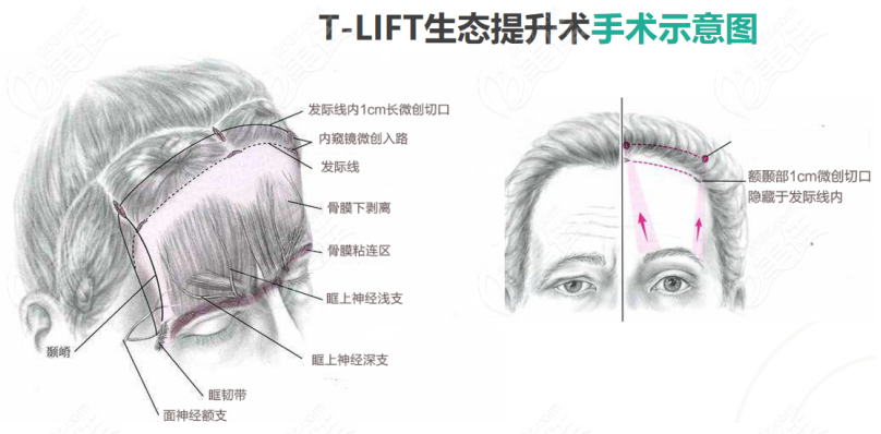 青岛波罗蜜做tlift长效复颜术多少钱？