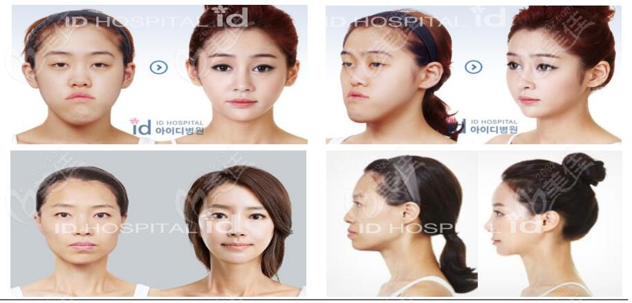 韓國id整形雙顎突嘴手術(shù)前后對比圖