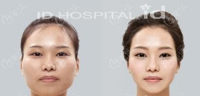 下頜角矯正雙鄂手術(shù)前后對比圖