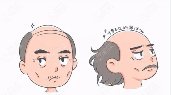秃顶的不去做植发手术是因为没有足够的毛囊可以移植