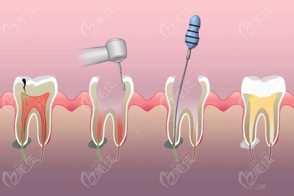 牙疼为什么要做根管治疗而不是吃消炎药保守治疗