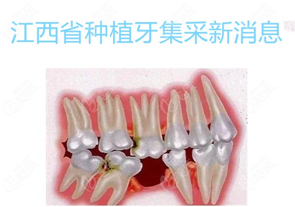 江西省种植牙集采新消息