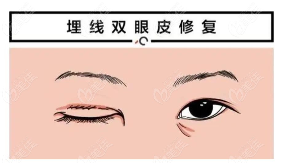 商丘修复双眼皮哪家好