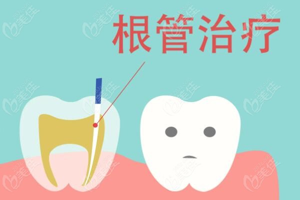 济南根管治疗价格