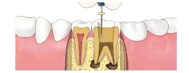 门牙根管治疗多少钱www.236z.com