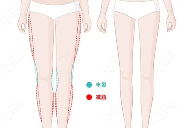 多维平行纤腿术能治疗O型腿吗www.236z.com