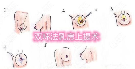 双环法乳房悬吊术是怎么做的
