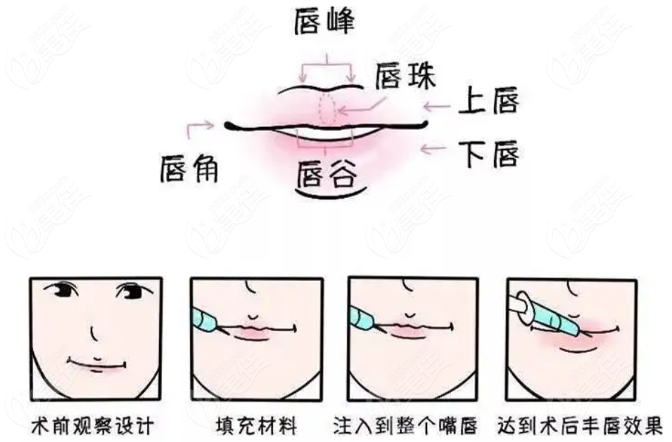 上海玻尿酸丰唇做的比较好的医生有谁
