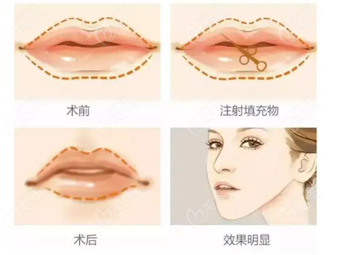 上海玻尿酸丰唇医生哪个做的比较好点