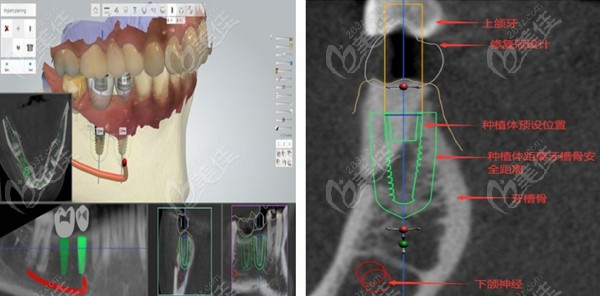 烟台德贝口腔3D数字化微创种植牙技术