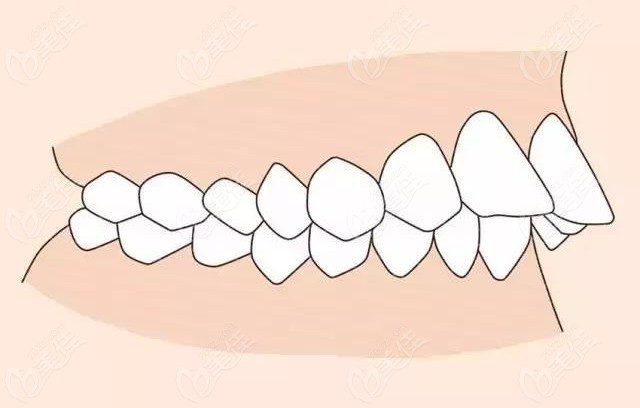 牙齿深覆合的图片对比图片