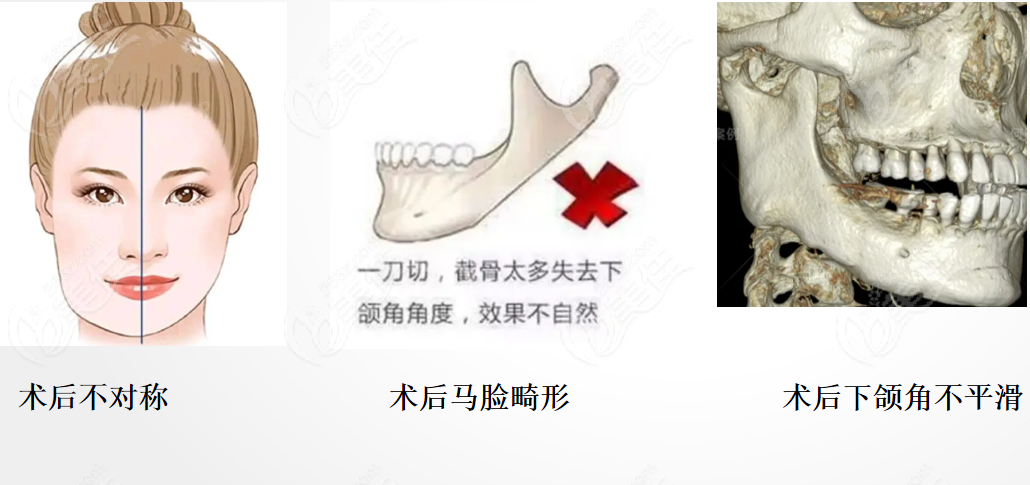 韩国欧佩拉整形面部轮廓修复怎么样