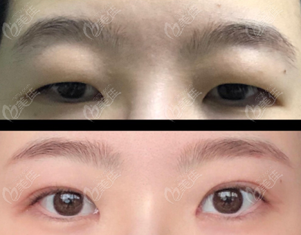 韩国歌柔飞双眼皮手术前后对比图