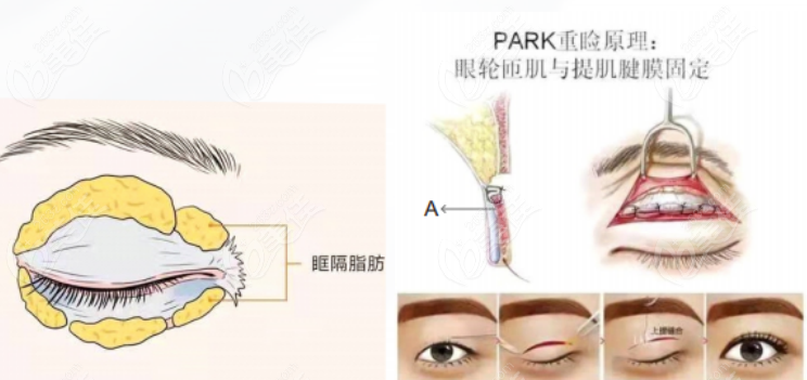 西安国医汪阳医生做双眼皮手术的技术怎么样？
