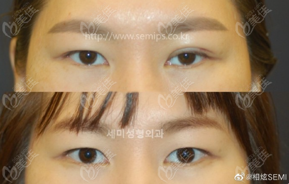 韩国世美双眼皮改单眼皮手术照片