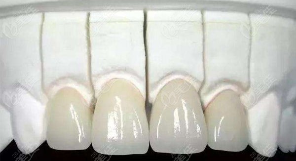 全瓷牙价格受多种因素影响