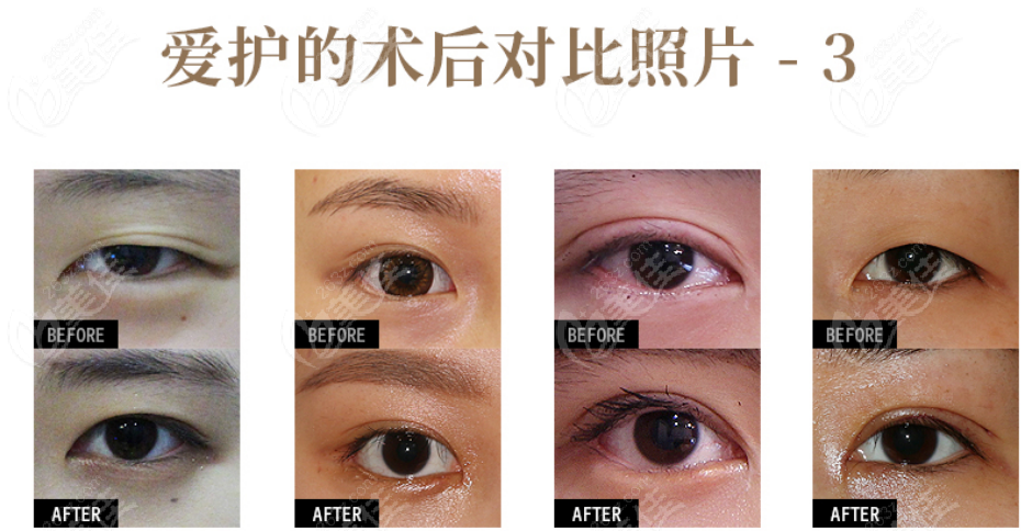 韓國愛護醫(yī)院樸炳浩醫(yī)生眼修復前后對比照片