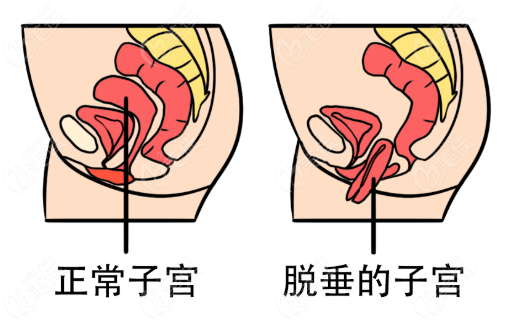 盆基底损伤容易导致子宫脱垂