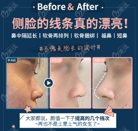 韩国ts整形外科李昇燦医生做鼻子真人对比照