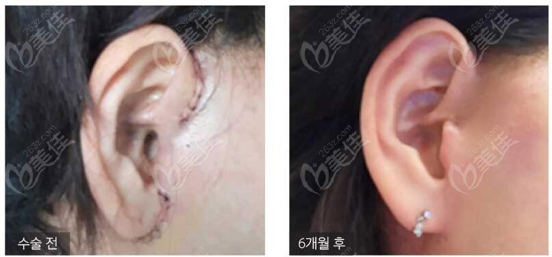金锡汉院长拉皮实例术后恢复不留疤