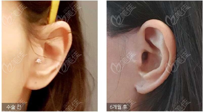 金锡汉做拉皮手术术后不用担心耳朵变形的问题