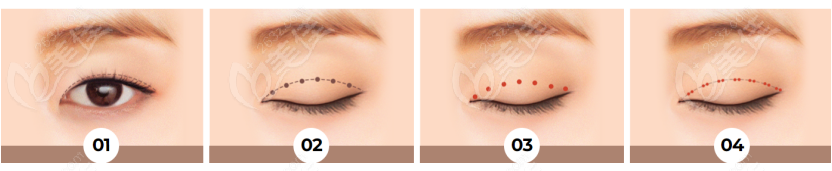 THE BB整形外科做双眼皮手术的流程
