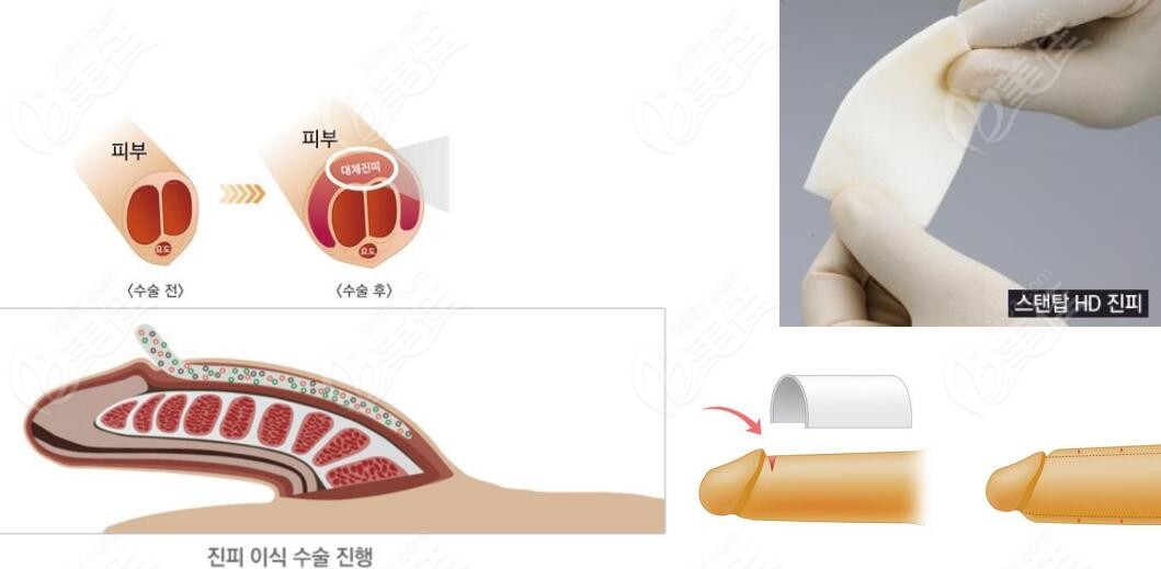 韩国世檀塔医院做男性阴茎增粗手术强