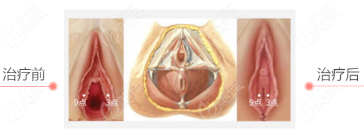 传统的阴道紧缩手术前后对比图