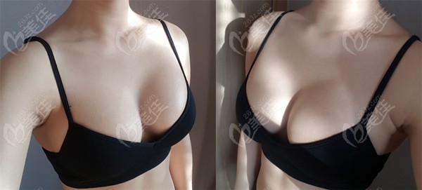 韩国假体隆胸前后对比图片
