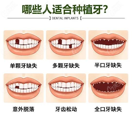 北京大兴区医院牙科收费标准之种植牙价格