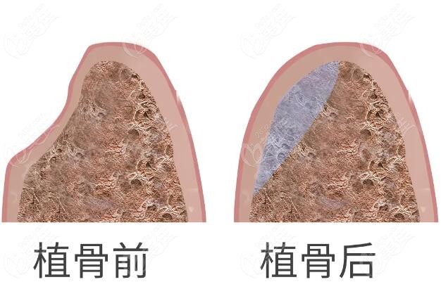 种植牙植骨手术